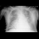 Interstitial lung edema: X-ray - Plain radiograph